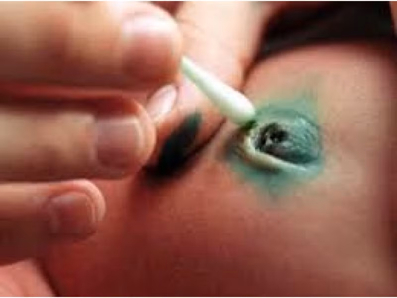 Tự ý bôi thuốc, chất lạ lên rốn. Tự ý bôi thuốc đỏ, các chất lạ, đắp lá, rắc hạt tiêu… đắp rốn với sái á phiện, phân bò lên cuống rốn bé theo kinh nghiệm thiếu khoa học từ dân gian. Những biện pháp này làm tăng nguy cơ nhiễm trùng rốn, hoặc làm trẻ chướng bụng, ngưng thở do ngộ độc á phiện, nhiễm trùng rốn sẽ nặng nề, khó điều trị và để lại di chứng như nhiễm trùng huyết, viêm màng não mủ, vàng da.