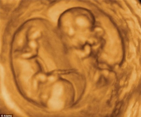 Trường hợp mầm phôi tách đôi muộn (trong tuần lễ thứ 2) sẽ dẫn đến đa thai cùng trứng chỉ có một túi ối và một túi đệm. Các trường hợp này thai ít khi sống được do dây rốn rối nhiều, tuần hoàn máu qua dây rốn bị nghẽn và một hay cả hai thai sẽ chết. Tỷ lệ đa thai cùng trứng có một ối chiếm tỷ lệ 1/4 trong tổng số các trường hợp song thai cùng trứng.