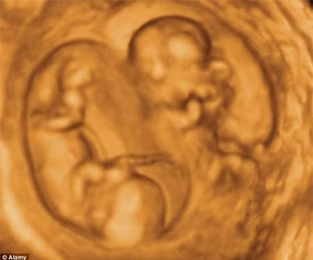 Trường hợp mầm phôi tách đôi muộn (trong tuần lễ thứ 2) sẽ dẫn đến đa thai cùng trứng chỉ có một túi ối và một túi đệm. Các trường hợp này thai ít khi sống được do dây rốn rối nhiều, tuần hoàn máu qua dây rốn bị nghẽn và một hay cả hai thai sẽ chết. Tỷ lệ đa thai cùng trứng có một ối chiếm tỷ lệ 1/4 trong tổng số các trường hợp song thai cùng trứng.