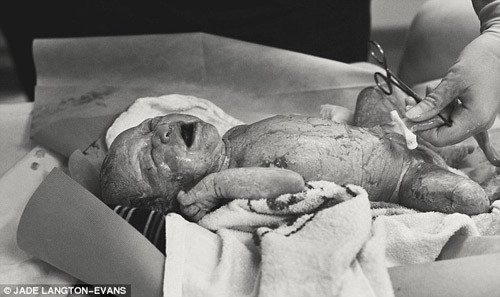 Mặt khác, Mary Ceallaigh, nhà tư vấn từ Texas (Mỹ) đang chủ trương nhân rộng lợi ích của mô hình "không cắt rốn", theo đó dây rốn của em bé được để tự nhiên sau khi ra đời. Chuyên gia cho biết hành động này có thể giúp cho cả mẹ và bé.