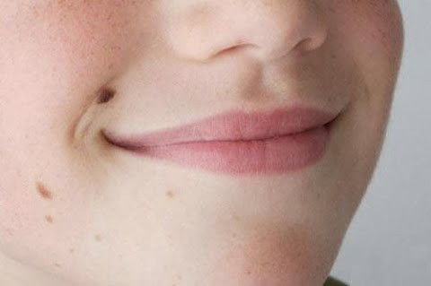 Tẩy nốt ruồi an toàn bằng giấm và tỏi. Rửa sạch các nốt ruồi để làm chúng mềm mại hơn. Dùng khăn hoặc tăm bông nhúng nước ấm liên tục chườm vào nốt ruồi ít nhất trong 15 phút. Điều này sẽ cho phép khi sử dụng giấm táo để loại bỏ các nốt ruồi một cách dễ dàng hơn. Tiếp theo, dùng tăm bông thấm giấm táo chấm lên nốt ruồi, tránh không để dính vào vùng da khác. Thực hiện 4 lần/ngày, sau 1 tháng, nốt ruồi của bạn sẽ biến mất.