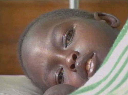 Triệu chứng cụ thể bao gồm: Sốt, đau đầu, đau cơ, đau khớp, suy nhược, tiêu chảy, nôn mửa, đau dạ dày và biếng ăn.