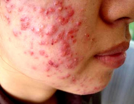 Khi đang bị viêm da. Các triệu chứng thường gặp là da ửng đó, sưng phù, nổi mụn nước... Hậu quả của việc này là gây ra bệnh viêm chân lông, kích thích lông tăng trưởng, giãn mạch máu khiến da bị khô và thô ráp.