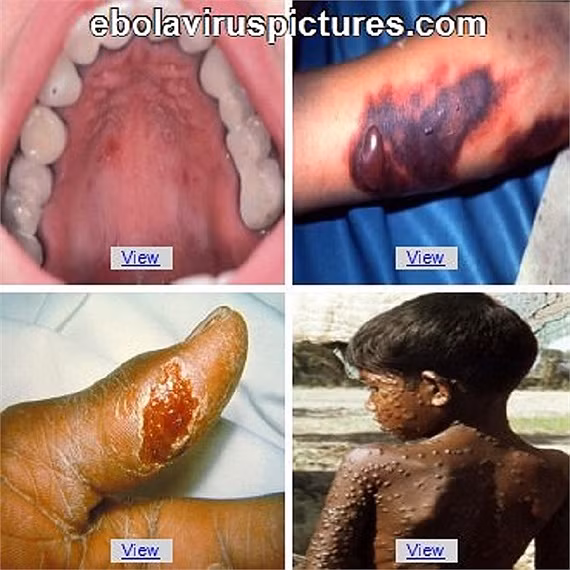 Virus Ebola tấn công cơ thể một cách có hệ thống, có nghĩa là nó tấn công mọi cơ quan và tế bào của cơ thể, ngoại trừ xương và cơ xương.