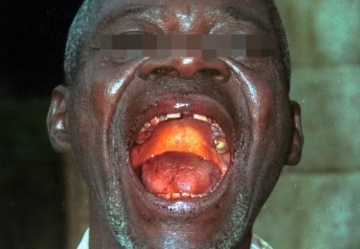 Virus Ebola gây ra các cục máu đông nhỏ trong máu của bệnh nhân; cục máu ngày càng nhiều lên và dòng chảy của máu chậm lại. Các cục máu đông bị tắc vào các mạch máu hình thành lên các đốm đỏ trên da bệnh nhân.