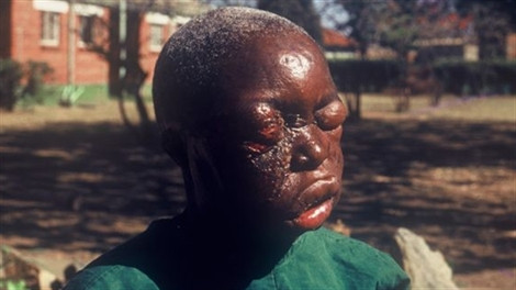 Đến giai đoạn cuối, bệnh nhân sẽ bị chảy máu từ miệng, mắt, tai, mũi và những vết hở trên da. Bệnh nhân sẽ chết do mất quá nhiều máu, suy thận, hoặc bị sốc. Bệnh có tỷ lệ tử vong lên tới 90%, chưa có thuốc đặc trị và chưa có vắc-xin phòng bệnh. Do đó, điều cần làm lúc này là phòng bệnh.