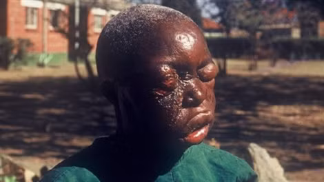 Đến giai đoạn cuối, bệnh nhân sẽ bị chảy máu từ miệng, mắt, tai, mũi và những vết hở trên da. Bệnh nhân sẽ chết do mất quá nhiều máu, suy thận, hoặc bị sốc. Bệnh có tỷ lệ tử vong lên tới 90%, chưa có thuốc đặc trị và chưa có vắc-xin phòng bệnh. Do đó, điều cần làm lúc này là phòng bệnh.