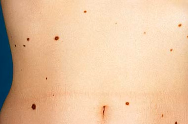 Không chỉ vậy khi bị giảm sức đề kháng, da dễ bị phồng rộp, nhiễm trùng… thậm chí là ung thư da nếu tiếp xúc nhiều với các hóa chất có hại.