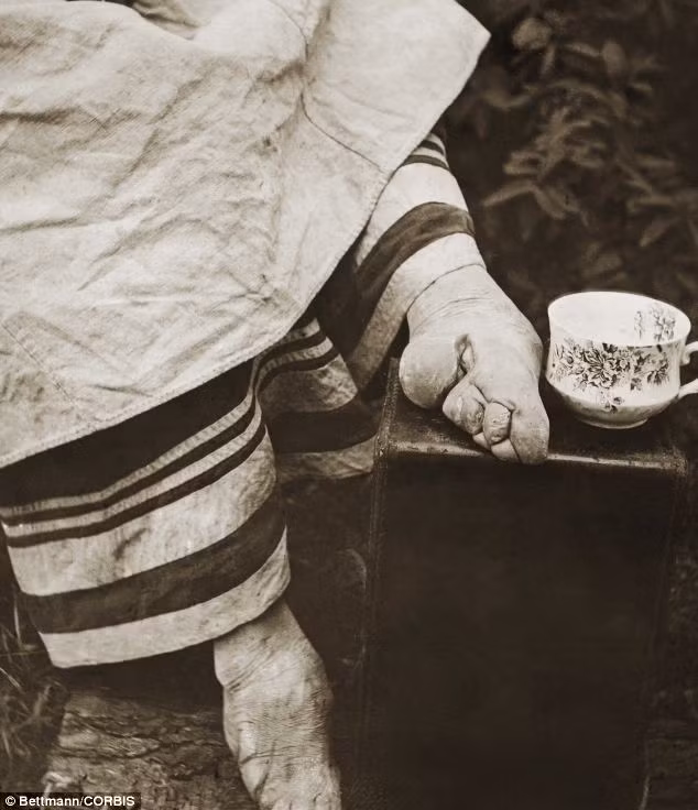 ...Tiếp đến, người lớn sẽ xoa bóp nhẹ nhàng bàn chân cho đứa trẻ rồi bẻ gẫy các ngón chân, trừ ngón cái rồi bó quặp tất cả 10 ngón sẽ được bó quặp về phía lòng bàn chân bằng những mảnh vải dài ngâm hỗn hợp. Đôi khi lòng bàn chân bé gái còn bị cắt vài vết rất sâu để các ngón chân dễ dàng nằm gọn trong đó.