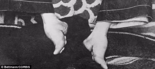 Hai ngày một lần, các mảnh vải bó chân lại được thay mới và thắt chặt hơn trước làm cho quá trình bó chân càng ngày càng đau đớn.