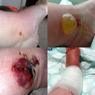 Vết thương của Julie nhiễm trùng nặng ở chân.