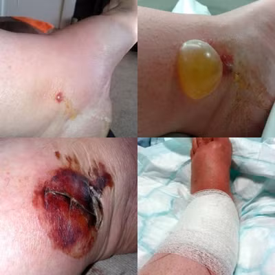 Vết thương của Julie nhiễm trùng nặng ở chân.