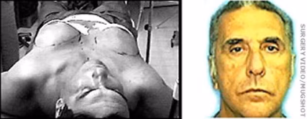 Năm 1999, cảnh sát Miami đã bắt giữ một bác sĩ giả hành nghề y khoa không có giấy phép. Ông này đã cấy nguyên cả một cặp vú đàn bà vào cơ thể nhà thể thao Baez.