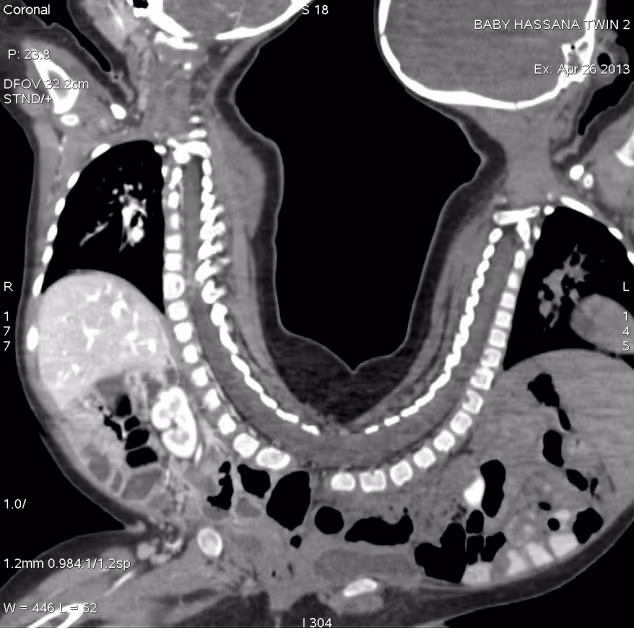 Để ca phẫu thuật được thành công, mỗi bước đi trong ca phẫu thuật phải được tính toán rất tỉ mỉ, và được tập dượt nhiều lần cho đến khi nó đạt được độ chính xác.