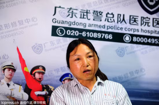 Độn cằm hỏng, khuôn mặt Dư Liên trở nên sập xệ và già nua như bà lão 60 tuổi.