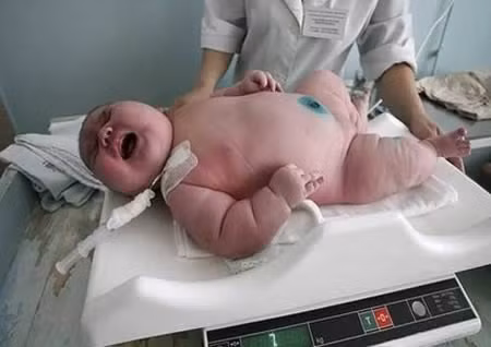 Ademilton dos Santos chào đời ngày 19/1/2005 nặng 7,7 kg và trở thành em bé nặng nhất Brazil từ trước tới nay. Bốn người con trước đó của cô Francisca Ramos dos Santos đều có trọng lượng bình thường. Các bác sĩ tin rằng, mẹ bé Ademilton dos Santos bị tiểu đường khi mang thai.