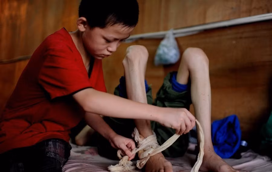 Cậu bé 12 tuổi thay băng cho bố.