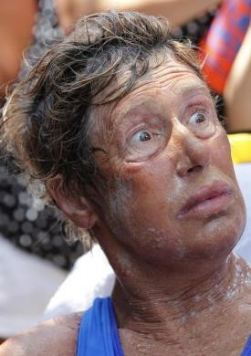 Bà Nyad bị cháy nắng, lưỡi và môi sưng phồng