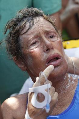 Bà Nyad bị cháy nắng, lưỡi và môi sưng phồng