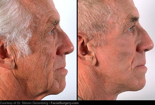  Trước và sau khi tái tạo da bằng tia la-ze. Thay vì phải sử dụng dao mổ, một số bệnh nhân lựa chọn cách khắc phục các nhược điểm, các nét thiếu hoàn hảo trên gương mặt bằng tia la-ze. Thủ thuật tái tạo bề mặt da bằng tia la-ze sử dụng chùm ánh sáng cực mạnh để tẩy các tế bào da bị tổn thương nằm gần trên bề mặt. Khi lớp da bên ngoài bị tẩy sạch đi, thì những đường chân chim li ti và những khiếm khuyết trên da cũng biến mất. Thủ thuật tái tạo bề mặt da bằng tia la-ze này có hiệu quả đặc biệt tốt đối với làn da bị tổn thương do ánh nắng mặt trời và các vết sẹo do mụn trứng cá để lại, như được minh họa trong hình đây. Tuỳ thuộc vào loại la-ze được sử dụng mà thời gian phục hồi có thể dao động từ 1 đến 2 tuần.