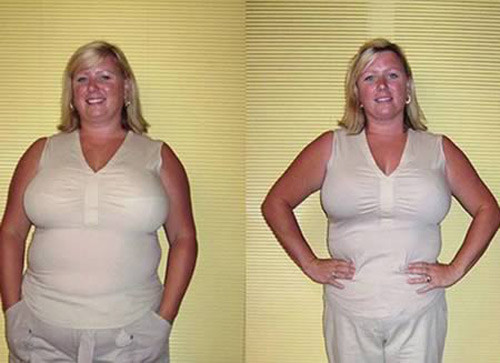 Thắt dạ dày. Cô Marion Corns, 35 tuổi đã bỏ ra 22,5 triệu VND để phẫu thuật thắt dạ dày. Cộng thêm chế độ ăn uống hợp lý, cô Marion Corn đã giảm được hơn 25kg. Hiện tại, cô vẫn có thể giám hơn 1,3kg/một tuần. Tuy nhiên, không phải ai cũng may mắn như Marion Corns. Các bác sĩ cảnh báo nhiều người có thể sẽ bị bục dạ dày nếu như không kìm chế được cơn nghiện ăn.