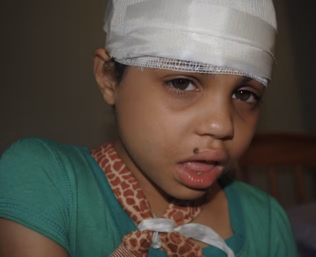 Hội chứng Landau-Kleffner. Đây là một rối loạn kỳ lạ được mô tả lần đầu tiên vào năm 1957 bởi 2 bác sĩ William M. Landau và Frank R. Kleffner. Bệnh thường xảy ra với trẻ khỏe mạnh, phát triển bình thường về cử động và ngôn ngữ, ở độ tuổi từ 5-7 tuổi. Trẻ biết nói và nói được ít nhiều rồi tự nhiên mất đi khả năng này, đột ngột hoặc từ từ, có trường hợp mất cả hai khả năng nghe hiểu ngôn ngữ và nói. Một số trẻ bị co giật, động kinh. Các nhà khoa học chưa tìm được nguyên nhân gây ra chứng rối loạn này vì đa số trường hợp trẻ phát bệnh tự nhiên không có nguyên nhân.