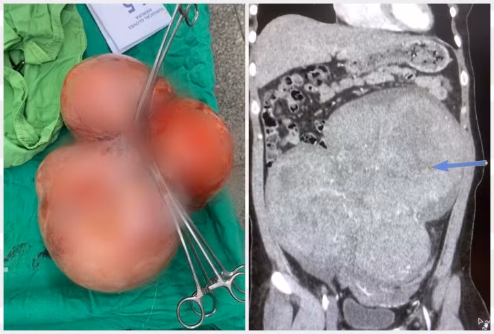 Nu benh nhan 35 tuoi co khoi u xo tu cung nang 5,5kg