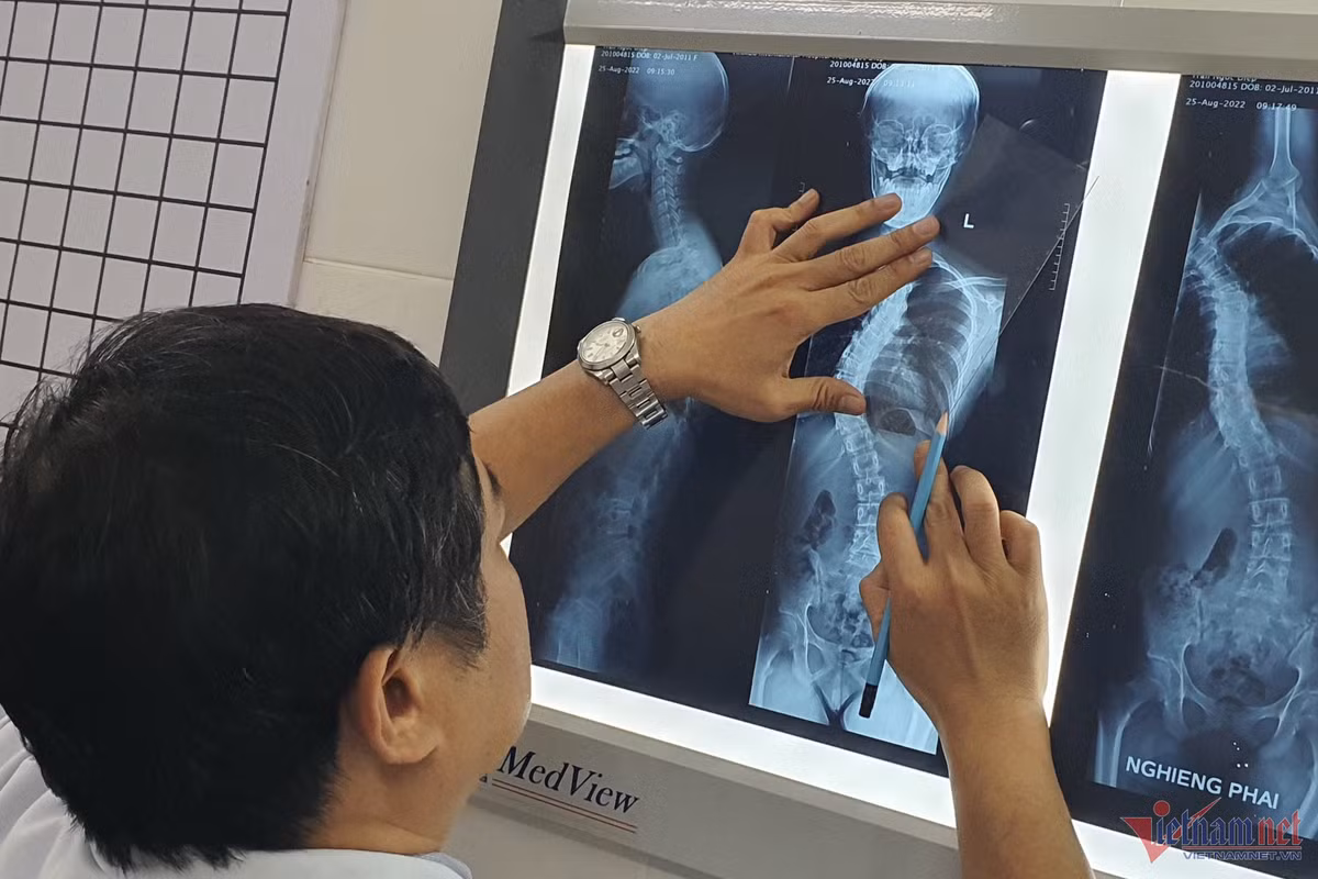 Can benh khien cot song uon cong nhu con rong