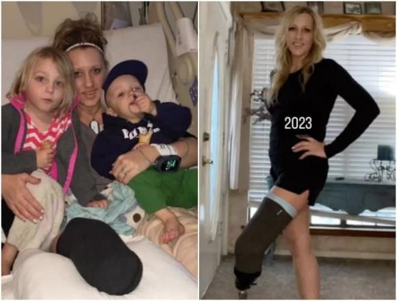 Ba me 5 con bi mat chan sau khi nhiem bo an thit-Hinh-5