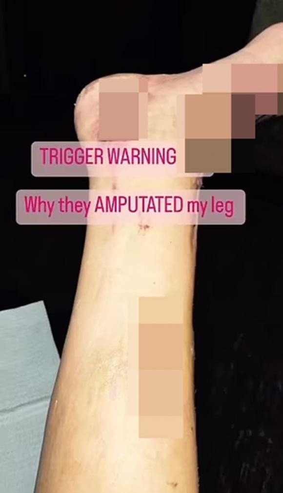 Ba me 5 con bi mat chan sau khi nhiem bo an thit-Hinh-2