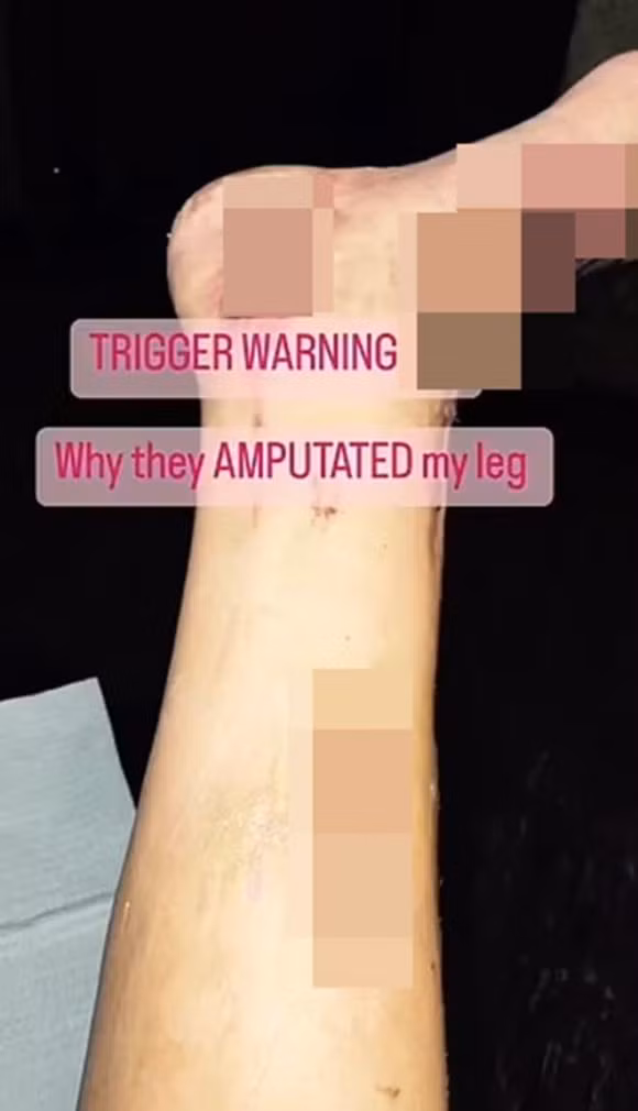 Ba me 5 con bi mat chan sau khi nhiem bo an thit-Hinh-2