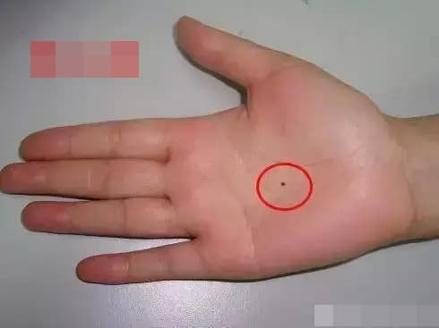 Not ruoi tren tay tuong trung cho dieu gi?-Hinh-2