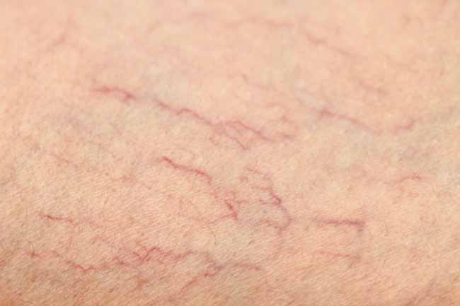 Suy tĩnh mạch: Suy tĩnh mạch là hiện tượng các mạch máu giãn nở bất thường do sự suy yếu thành mạch. Các chuyên gia ước tính gần 50% phụ nữ độ tuổi 40 - 50, và gần 75% phụ nữ độ tuổi 60 - 70 mắc chứng suy yếu tĩnh mạch chân.