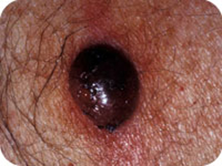 U da nodular melanoma. Dù không nguy hiểm như u da melanoma song u da nodular melanoma có tốc độ di căn cực nhanh. Từ một khối u nhỏ, nó nhanh chóng tăng trưởng về kích thước, màu sắc.