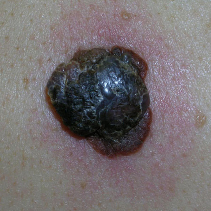 Bạn có thể nhận dạng khối u nodular melanomas do chúng thường có màu đỏ, hồng, nâu hoặc đen nhạt. Đặc biệt, chúng thường có viền ngoài, hình vòm. Sau thời gian phát triển, u da nodular melanoma nhanh chóng tróc vảy và chảy máu gây khó chịu.