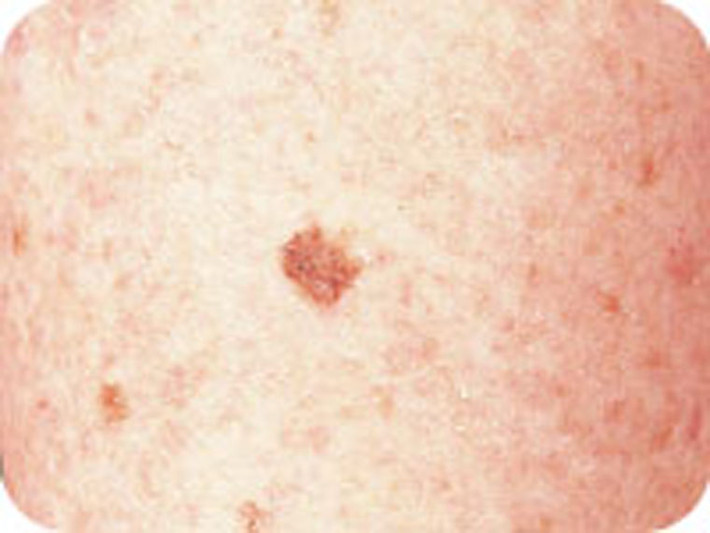 Ung thư da melanoma. Đây được xem là dạng ung thư da ác tính nguy hiểm nhất. Nếu không được điều trị kịp thời, tế bào ung thư dễ dàng di căn tới bộ phận khác trong cơ thể.