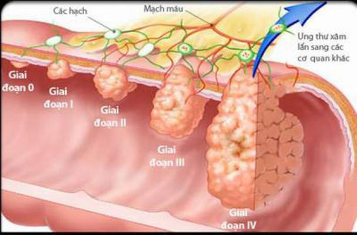 Ở giai đoạn 0, bệnh nhân không có nhiều biểu hiện bất thường, rất khó được phát hiện. Tại thời điểm này, tế bào ung thư mới xuất hiện ở niêm mạc bên trong, còn gọi là ungthư biểu mô.