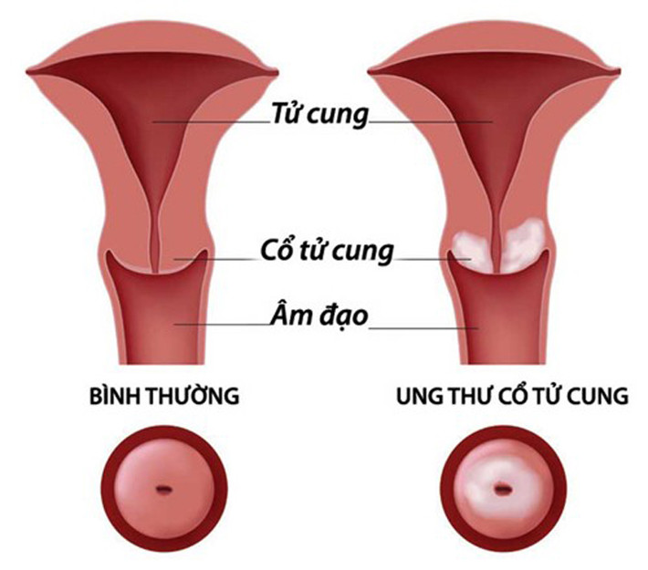 Ung thư cổ tử cung. Chị em cần hết sức chú ý nếu thấy đau nhức quanh vùng chậu, chuột rút ở những ngày không có kinh nguyệt, chảy máu âm đạo, tiểu tiện, dịch âm đạo bất thường, đau hoặc chảy máu sau khi sex… bởi chúng có thể là dấu hiệu cảnh báo sớm căn bệnh ung thư buồng trứng nguy hiểm.