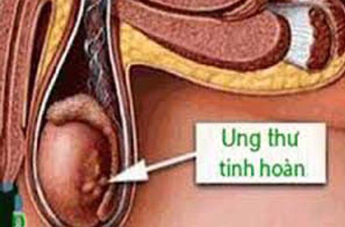 Tinh hoàn một trong những tuyến sinh dục có nhiệm vụ sản xuất và chứa tinh dịch, các hormone nam có chức năng kiểm soát sự phát triển của cơ quan sinh sản và đặc tính nam. Tế bào ung thư có thể xuất hiện ở một hoặc cả hai bên tinh hoàn.