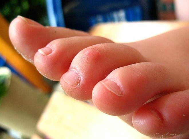 Tổn thương vĩnh viễn: Khi đi dép xỏ ngón, bàn chân buộc phải đảm nhận vị trí "gọng kìm" để không bị mất độ bám. Về lâu dài, tư thế không tự nhiên này khiến các ngón chân bị cong, gây biến dạng ngón chân.