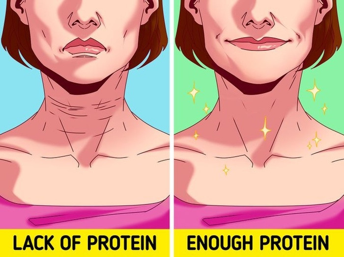 5. Thiếu protein Chế độ ăn hạn chế lượng calo và quá ít protein có thể ngăn cản các tế bào da tự tái tạo, khiến da của bạn mất độ đàn hồi, từ đó dẫn đến nhiều nếp nhăn hơn. Điều trị bằng collagen cũng có thể giúp ích trong những trường hợp này nhưng nó không đáng kể gì so với những ảnh hưởng của việc thiếu protein.