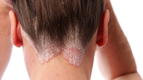 Bệnh vảy nến. Đây là một trong những bệnh về da thường gặp nhất. Vảy nến là một dạng tự miễn dịch gây ra các đốm đỏ, vảy ngứa. Căn nguyên bệnh vảy nến còn nhiều điểm chưa sáng tỏ, nhưng đến nay hầu hết các chuyên gia thống nhất bệnh có liên quan đến các rối loạn miễn dịch và yếu tố di truyền. Điều này đồng nghĩa với việc dù gây khổ sở cho người bệnh song vảy nến về bản chất không lây truyền.