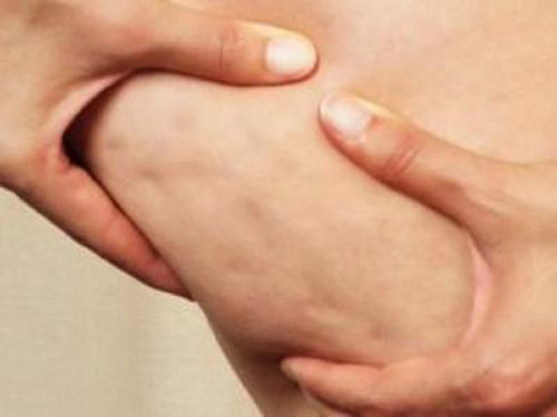 Da sần vỏ cam (cellulite) là thuật ngữ dùng để chỉ hiện tượng bề mặt da bị sần sùi, lồi lõm, thô nhám, nổi hạt nhỏ trông như vỏ cam. Thay vì trải đều mịn màng, các túi mỡ dưới da bị chèn ép, làm giãn các sợi collagen, gây nên tình trạng xơ cứng mô liên kết.
