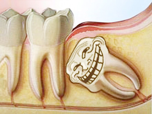 Răng khôn. Trước đây, răng khôn chưa bao giờ là một vấn đề của con người. Thực tế, răng không thay đổi kích thước. Chúng mọc lên từ trước khi bạn cần dùng và sau đó chúng nhô hẳn ra khỏi hàm. Hàm là xương, và như những phần khác của cơ thể bạn, nó cần được hỗ trợ và sử dụng để phát triển đúng cách. Khi con người hiện đại ăn thực phẩm mềm, đã được nấu chín như trẻ em, hàm của chúng ta không phát triển hết khả năng.