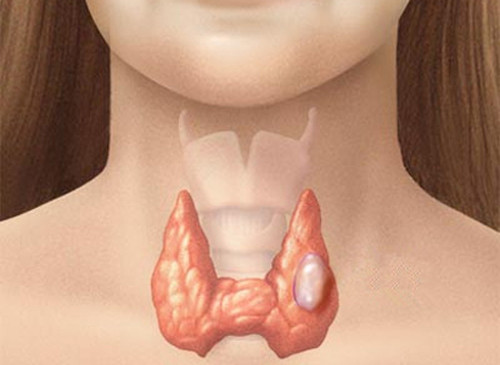Isoflavone trong sữa đậu nành có ảnh hưởng tiêu cực đến sự tổng hợp hormone tuyến giáp do nó ngăn chặn các enzyme peroxidase tuyến giáp. Loại hormone này có nhiệm vụ hỗ trợ i-ốt sản xuất hormone tuyến giáp nên nếu thiếu nó sẽ làm cho hormone tuyến giáp giảm, gây ra tình trạng suy tuyến giáp.