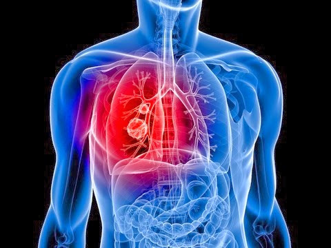 Tắc nghẽn phổi mạn tính. Tắc nghẽn phổi mạn tính (COPD) cũng là một trong những nguyên nhân gây ho nghiêm trọng và kéo dài. Ngoài ho, COPD còn khiến người bệnh gặp khó khăn trong quá trình hô hấp. Bệnh thường “hỏi thăm” đối tượng có thói quen hút thuốc lá, tiếp xúc nhiều khói bụi.