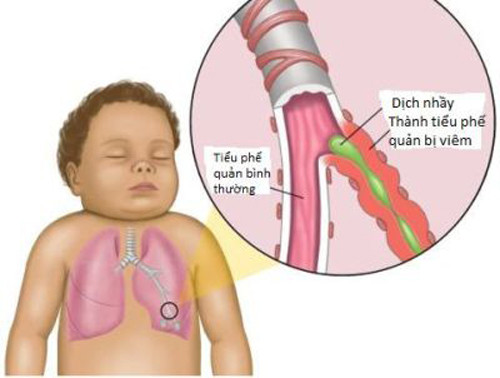 Một trong những nguyên nhân phổ biến sau những cơn ho kéo dài là chứng viêm phế quản. Viêm phế quản thường kéo theo ho kể cả khi đã khỏi bệnh. Nguyên nhân bởi siêu vi cảm, cúm có thể làm viêm đường thở trong nhiều tuần khiến các ống thở nhạy cảm hơn với những tác nhân gây ho bên ngoài. Chứng cảm, cúm cũng có thể khiến nước sau mũi tiếp tục chảy xuống họng một thời gian dài gây ra ho.