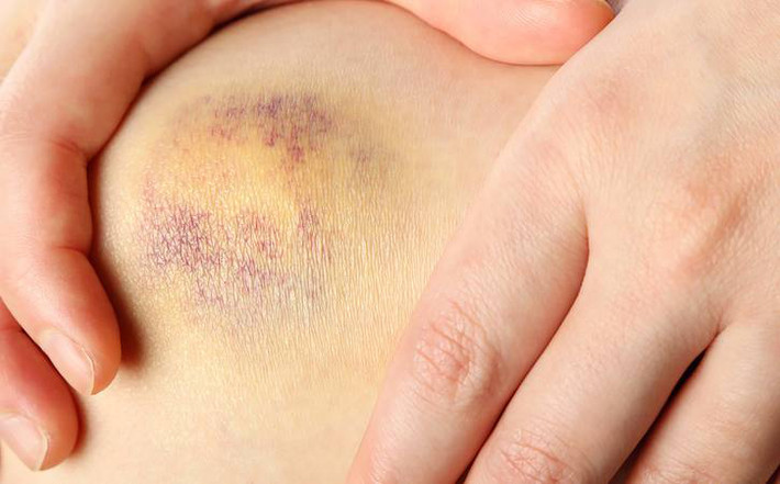 Bầm tím quá mức:Theo Trung tâm điều trị ung thư Mỹ, những vết bầm tím bất thường có thể là một triệu chứng bệnh bạch cầu.