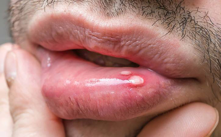 Lở loét hoặc đau ở miệng: Những vết loét miệng thường không đáng lo ngại. Tuy nhiên, nếu bạn nhận thấy vết loét không lành, các mảng trắng hoặc đỏ xuất hiện trên nướu răng, lưỡi và bạn bị sưng hoặc tê hàm thì đó có thể là dấu hiệu của một số bệnh ung thư miệng.