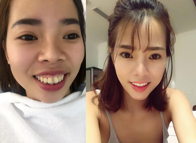 Nhan sắc kém xinh khiến Thanh Thủy (sinh năm 1989, Hà Nội) gặp nhiều trở ngại trong công việc và cuộc sống. Cô đã chi 200 triệu đồng phẫu thuật nâng mũi, độn cằm, bọc răng sứ để trở nên xinh đẹp hơn.